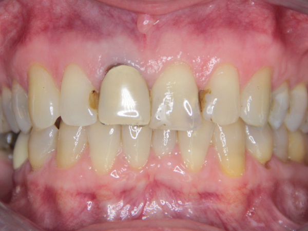 CERAMIC E.MAX CROWNS, AESTHETIC ROOT EXTENSION AND COMPOSITE FILLINGS